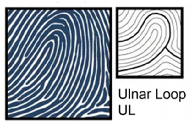 ULNAR LOOP (UL)